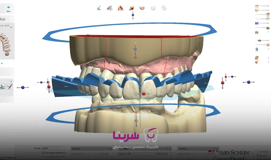 قالبگیری ایمپلنت دندان با اسکنر دیجیتال در سریتا