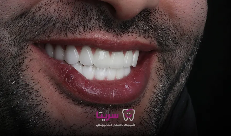 خوبی ها و مزایای روکش ایمپلنت دندان