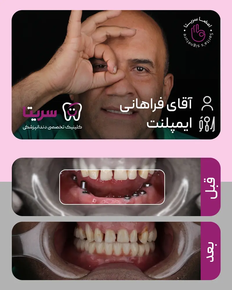 نمونه کار ایمپلنت دندان جلو، قبل و بعد ایمپلنت دندان جلو