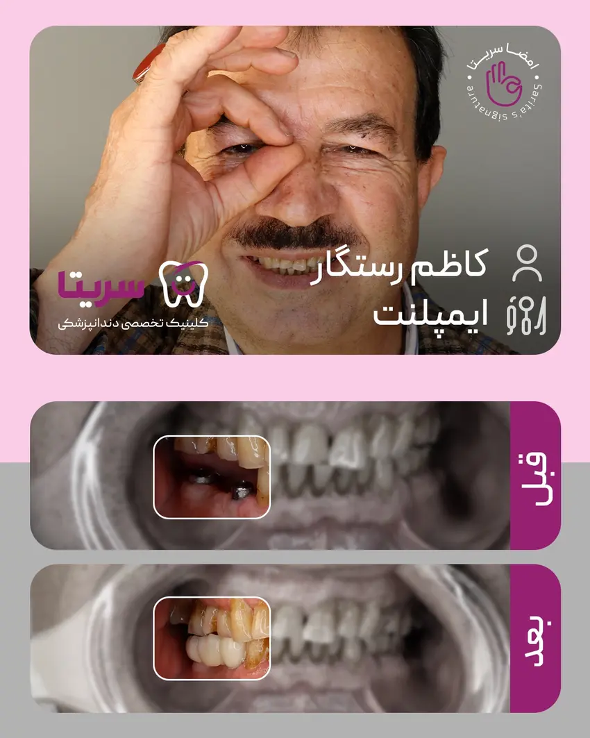 نمونه کار قبل و بعد ایمپلنت دندان 