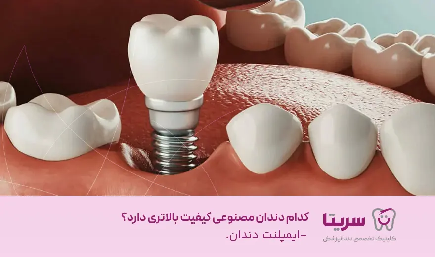 ایمپلنت دندان بالاترین کیفیت را بین دندان مصنوعی ها دارد و برای حوانان هم توصیه می شود