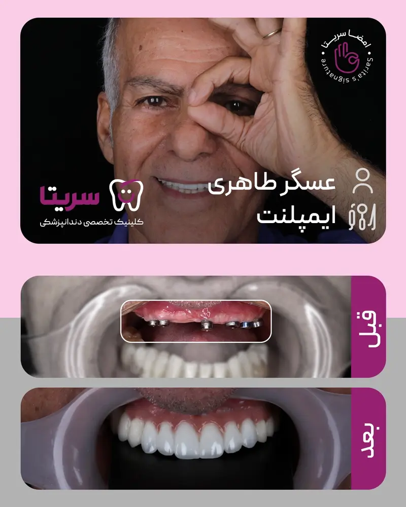 ایمپلنت اقساطی دندان