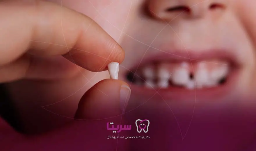 ایمپلنت دندان شیری