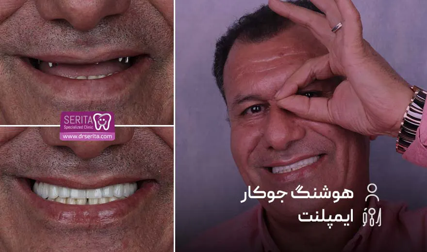 قبل و بعد ایمپلنت دندان، کلینیک تخصصی ایمپلنت دندان