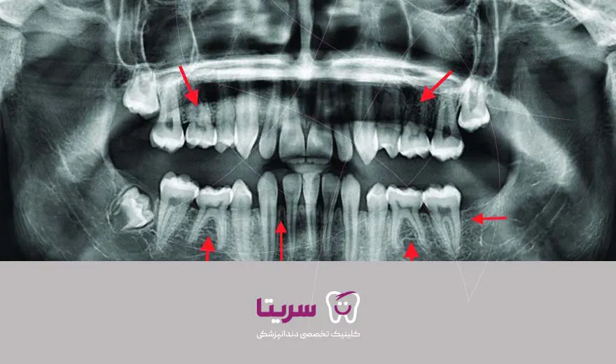 آژنزیس دندان 