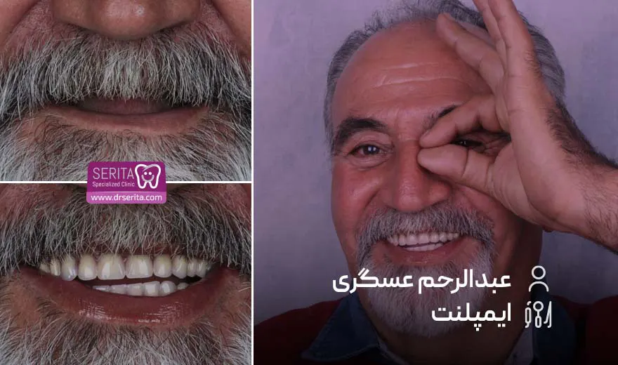 قبل و بعد ایمپلنت دندان کلینیک سریتا