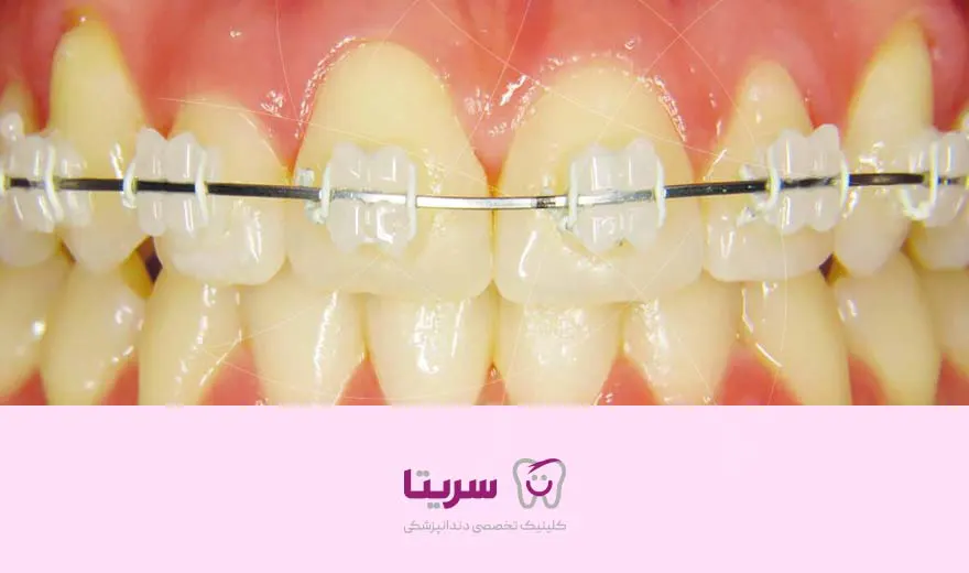 زرد شدن دندان ها بعد از ارتودنسی