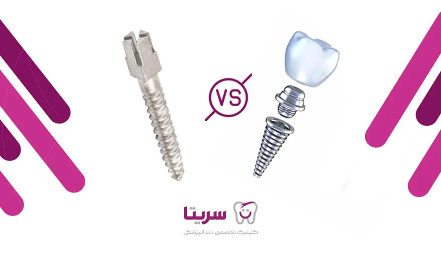 تفاوت پین دندان و ایمپلنت دندان