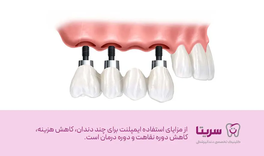 مزایای استفاده از ایمپلنت برای چند دندان، ایمپلنت برای دو دندان کنار هم