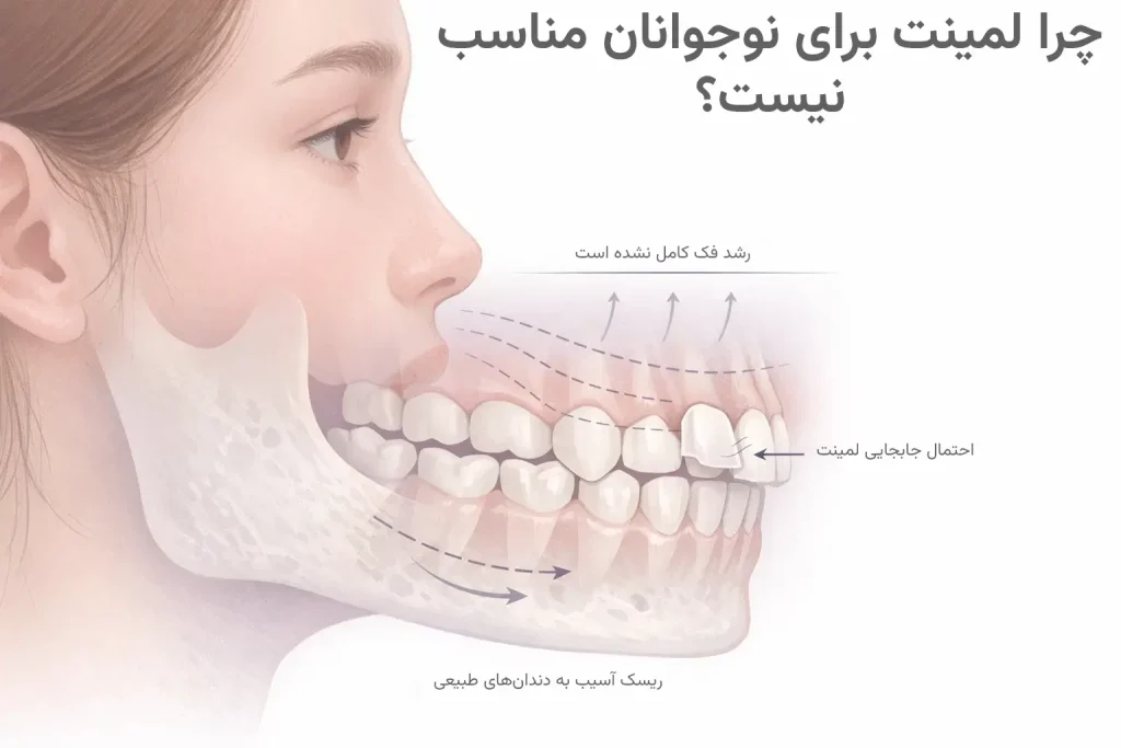 اینفوگرافیک آیا لمینت برای نوجوانان مناسب است؟
