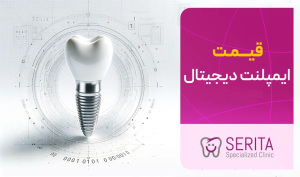 قیمت ایمپلنت دیجیتال در تهران ۱۴۰۴ (شرایط اقساطی)