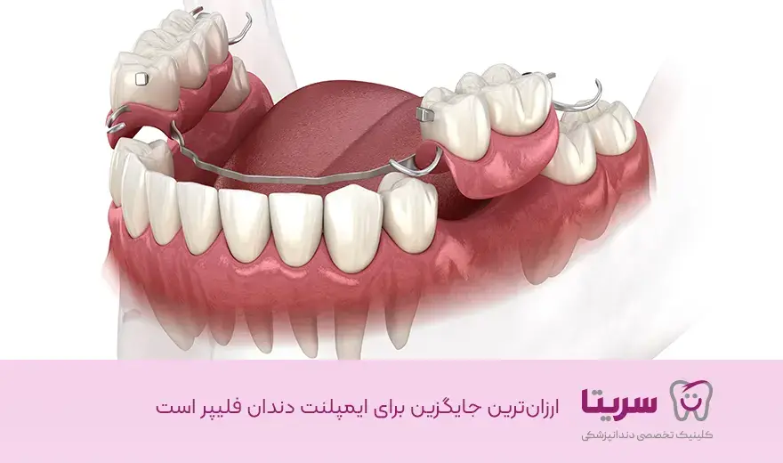 ارزان ترین جایگزین برای ایمپلنت دندان