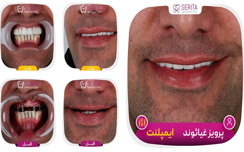 نمونه واقعی ایمپلنت دندان در کلینیک سریتا
