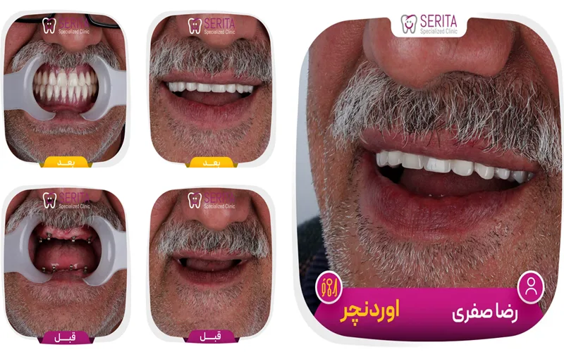 نمونه واقعی اوردنچر دندان در کلینیک سریتا