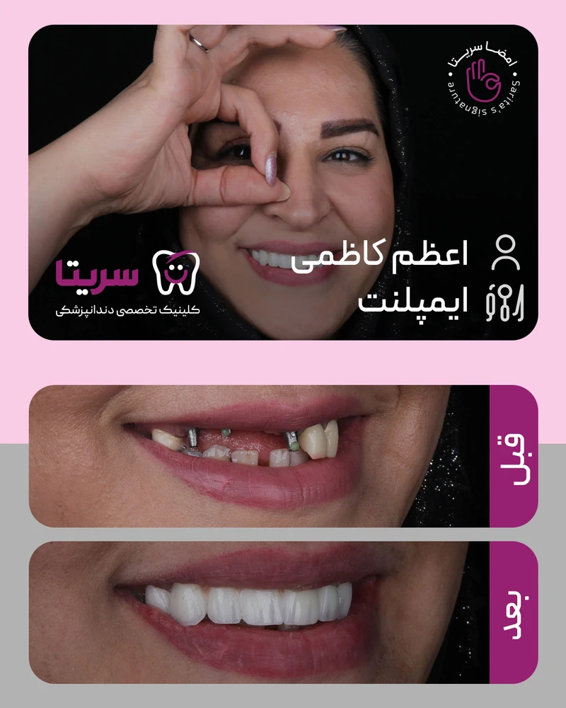 عکس قبل و بعد ایمپلنت دندان جلو کلینیک سریتا
