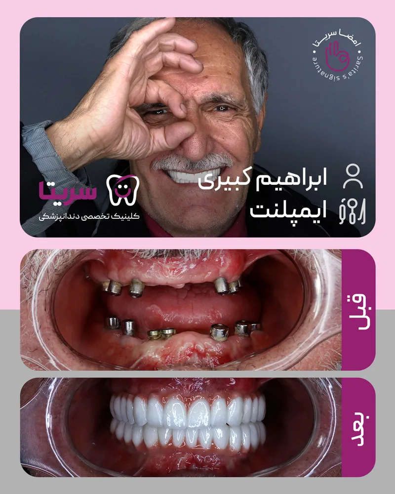 نمونه کار قبل و بعد دندان مصنوعی ثابت بر پایه ایمپلنت
