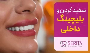سفید کردن داخل دندان یا بلیچینگ داخلی دندان