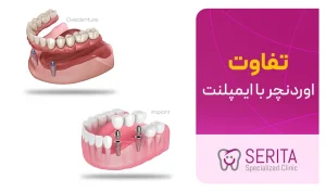فرق اوردنچر با ایمپلنت دندان چیست؟