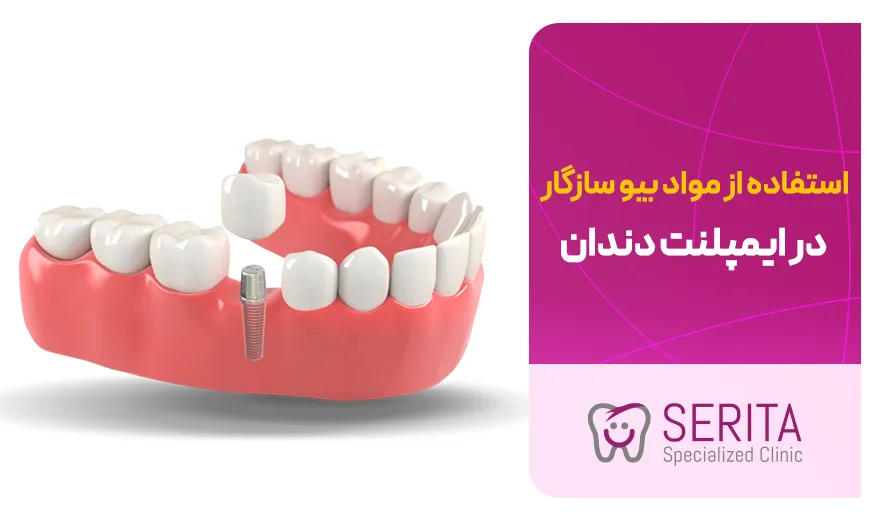 استفاده از مواد بیوسازگار در ایمپلنت دندان
