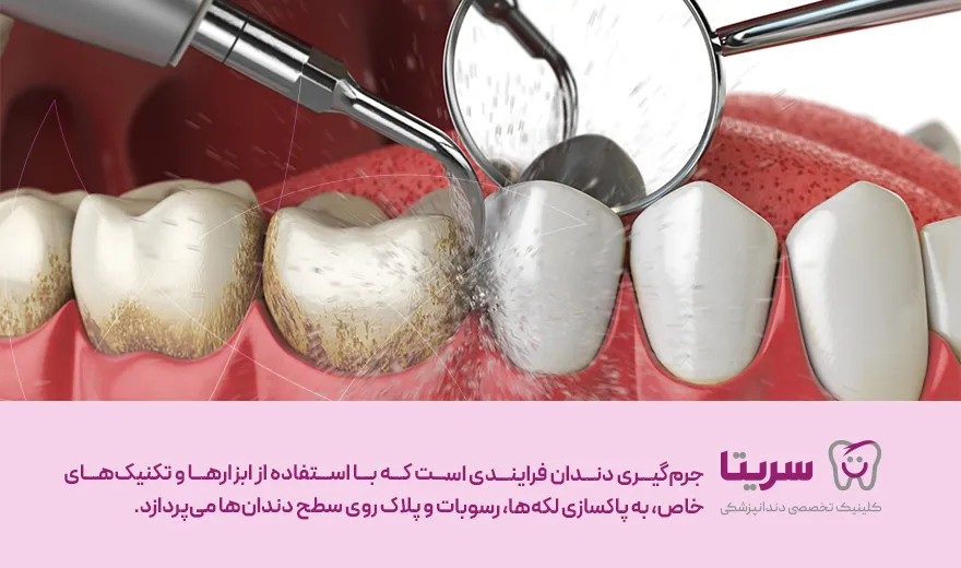 جرم گیری دندان چیست