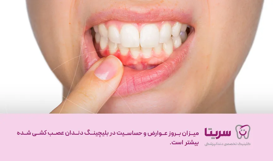 عوارض بلیچینگ دندان عصب کشی شده