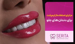 اهمیت ایمپلنت دندان برای دندان های جلو