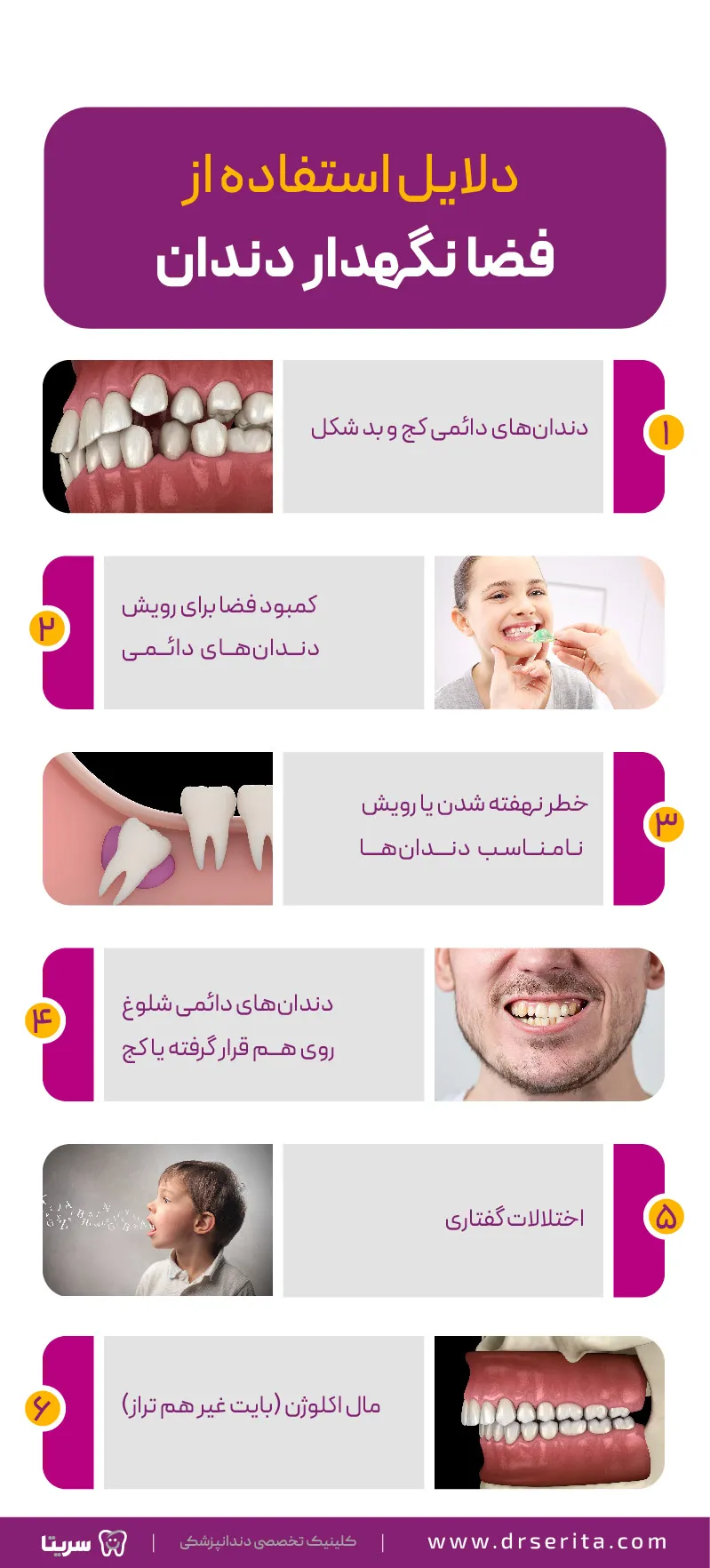 دلایل استفاده از فضا نگهدارنده دندان