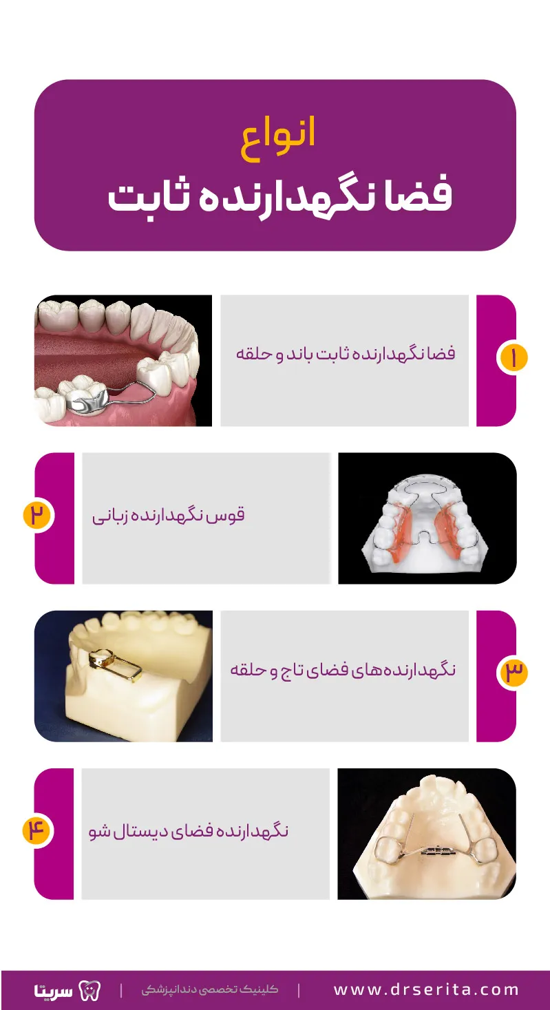 انواع فضا نگهدارنده دندان