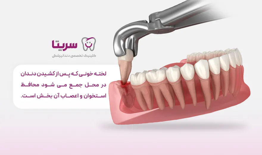 علت درد شدید پس از کشیدن دندان