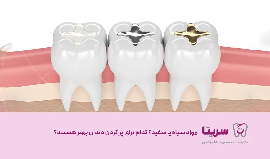 مواد سیاه یا سفید، کدام برای پر کردن دندان بهتر هستند؟