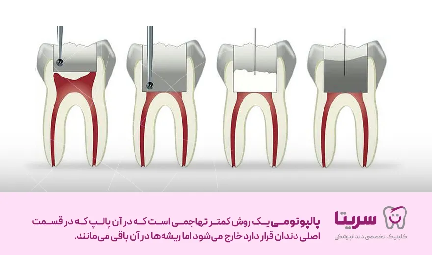 پالپوتومی دندان چیست