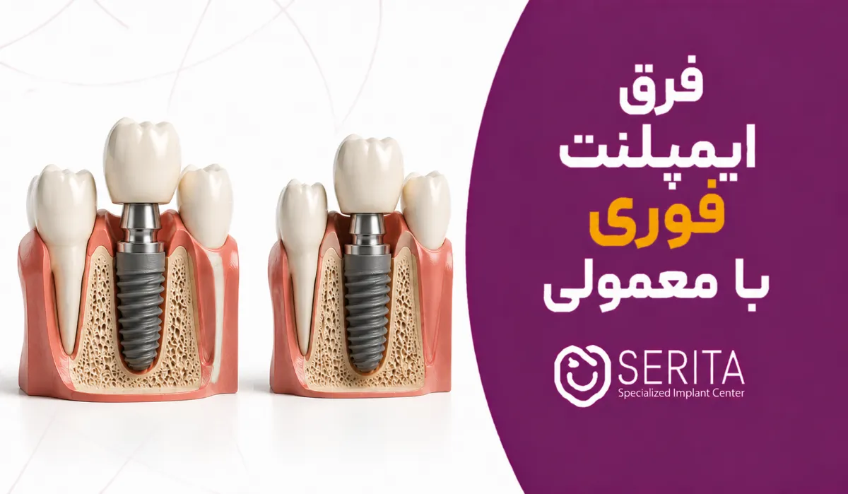 فرق ایمپلنت فوری و معمولی چیست؟ کدام روش برای شما مناسب‌تر است؟