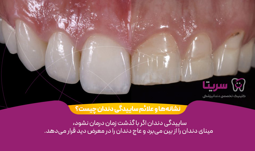 عوارض ساییدگی دندان