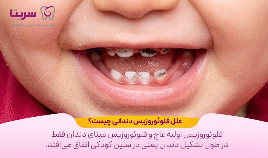 علل فلوئوروزیس دندانی چیست؟