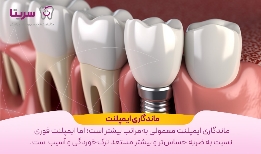 ماندگاری ایمپلنت دندان