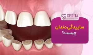 ساییدگی دندان چیست؟