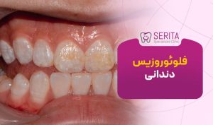 فلوئوروزیس دندانی یا Dental fluorosis چیست؟