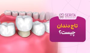 تاج دندان چیست؟