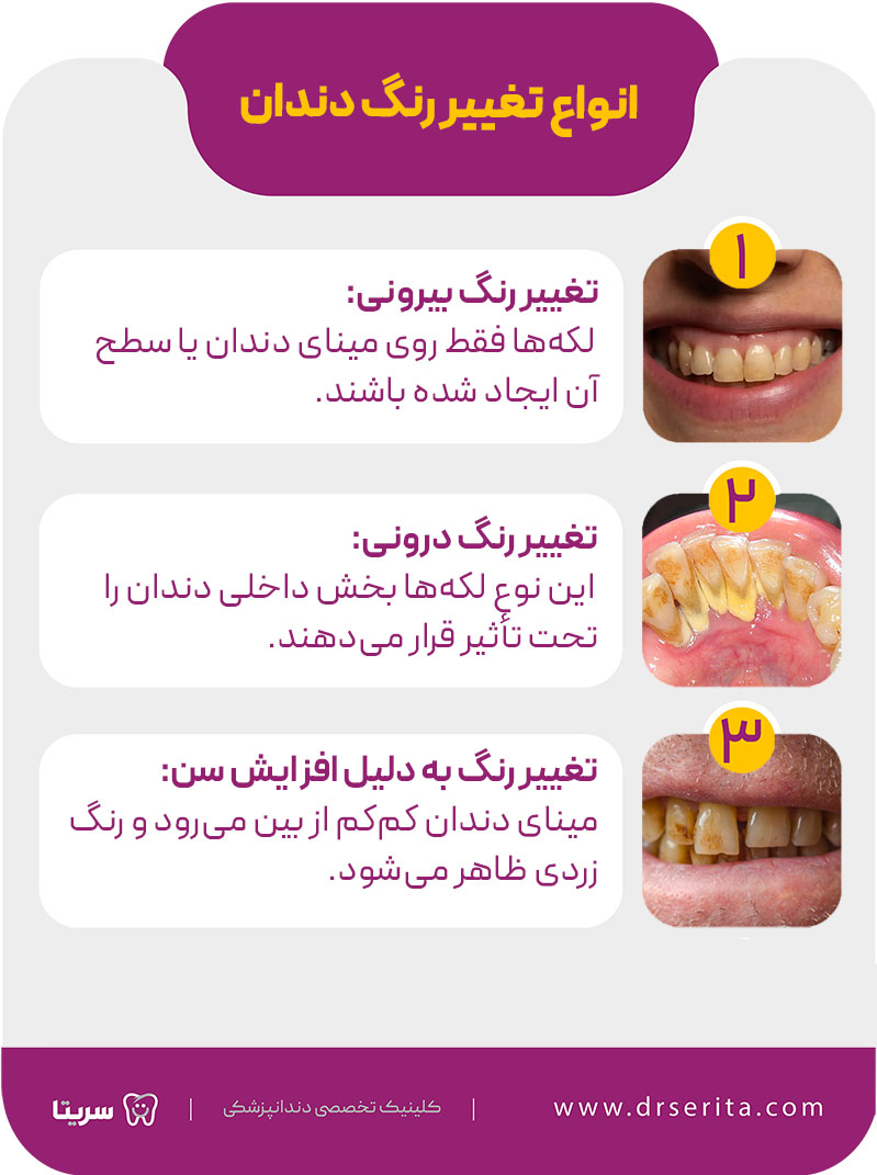 انواع تغییر رنگ دندان