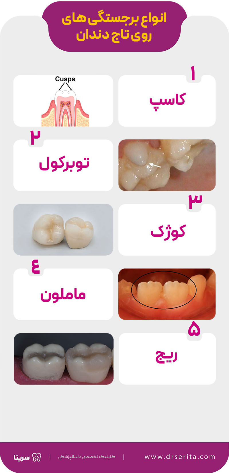 انواع برجستگی های روی دندان