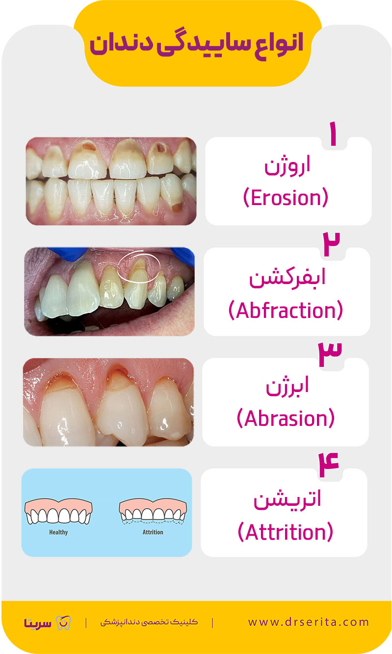 انواع ساییدگی دندان