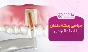 جراحی ریشه دندان یا اپیکواکتومی چیست؟
