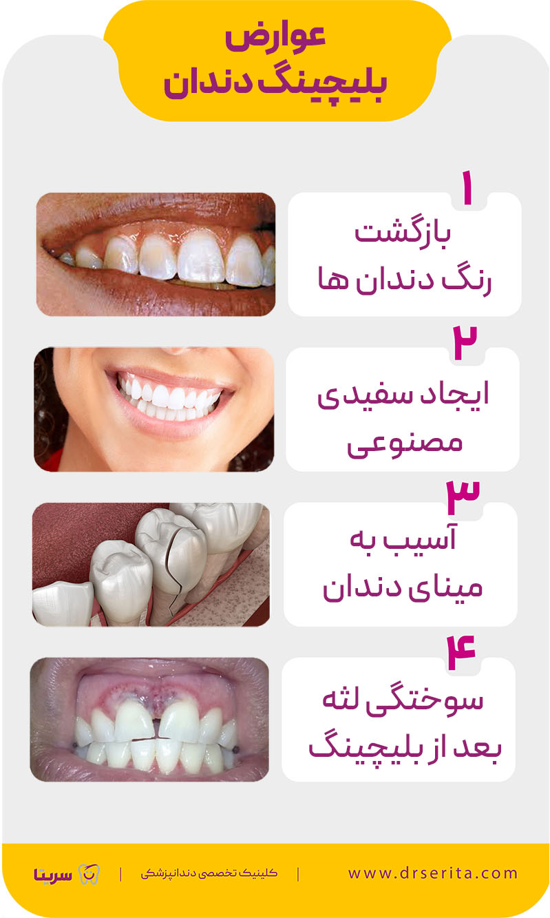 عوارض بلیچینگ دندان