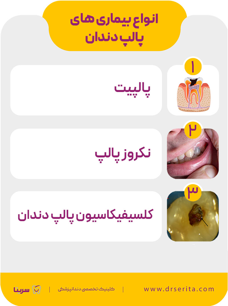 انواع بیماری های پالپ دندان