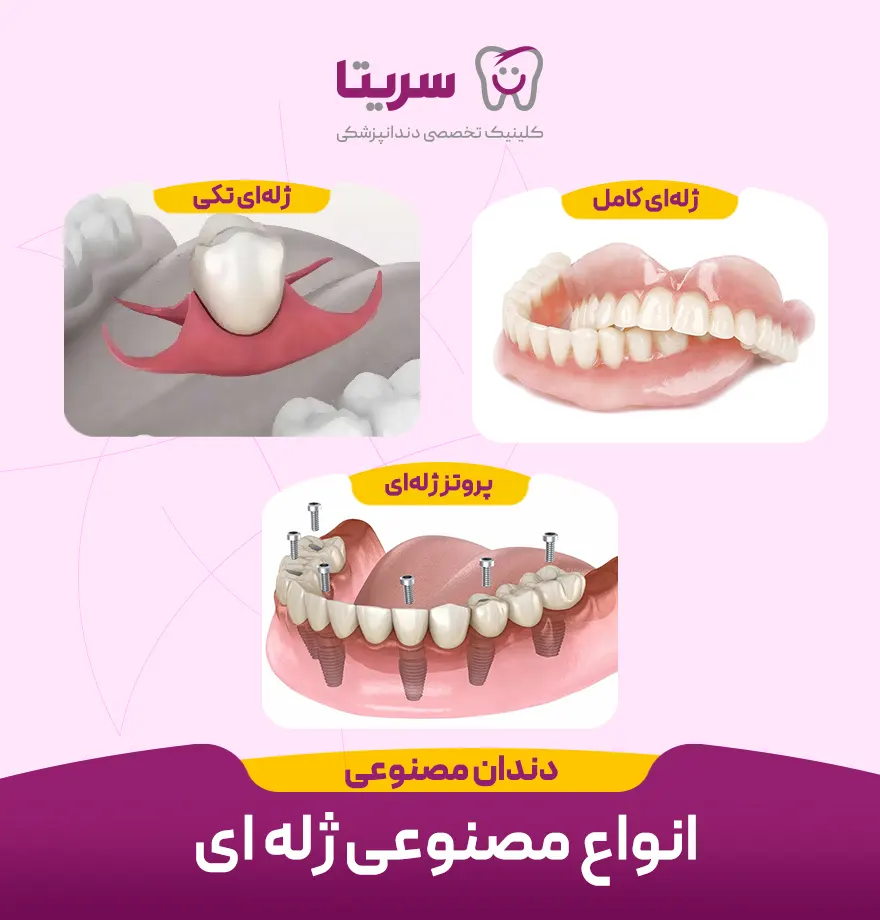 انواع دندان مصنوعی ژله ای