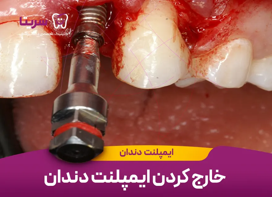 خارج کردن ایمپلنت دندان