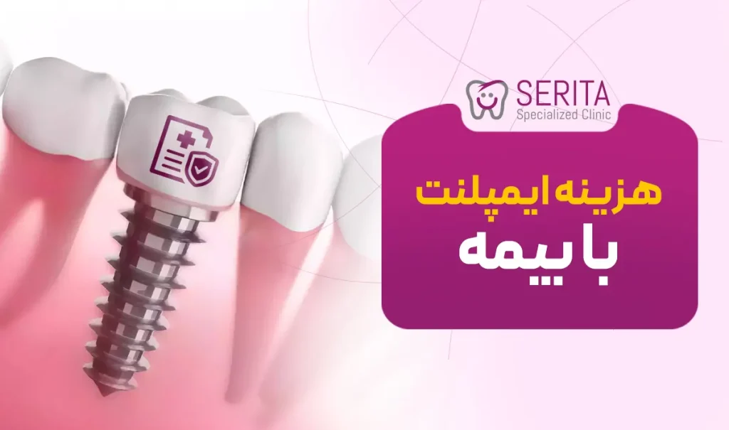 هزینه ایمپلنت با بیمه