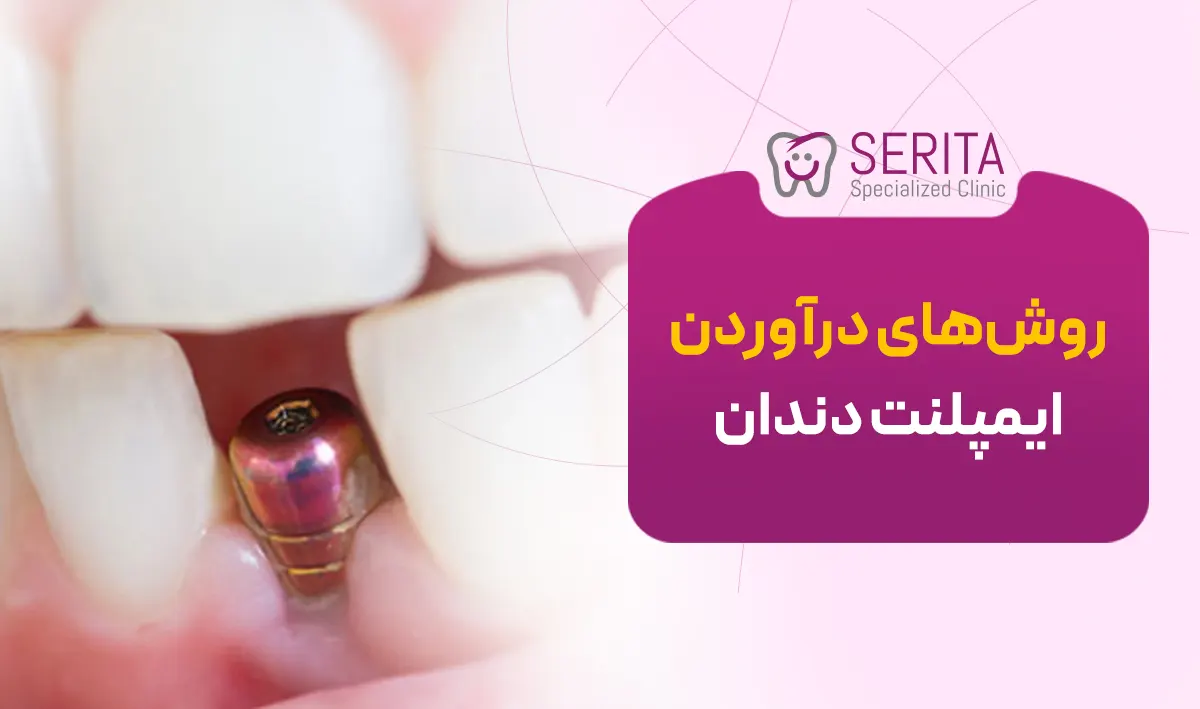 روش های درآوردن ایمپلنت دندان