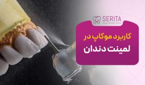 کاربرد موکاپ در لمینت دندان