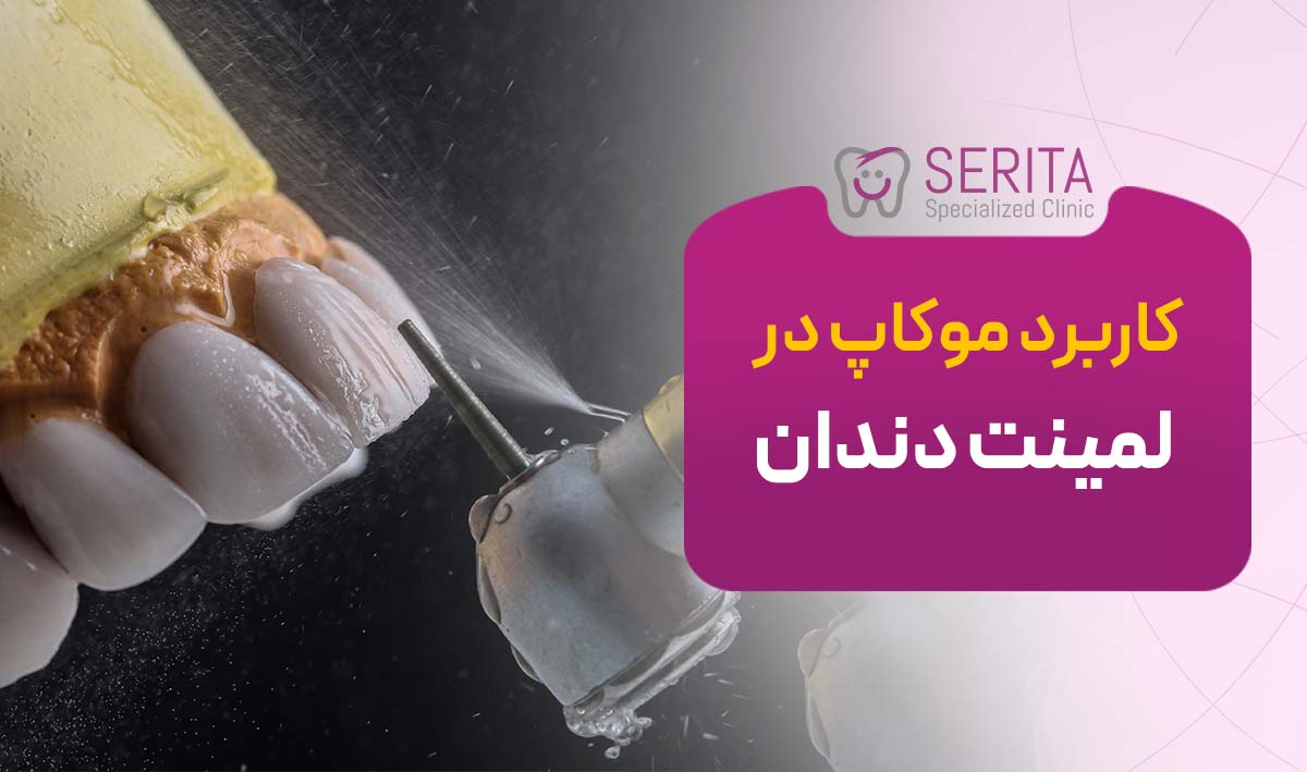 موکاپ لمینت دندان چیست